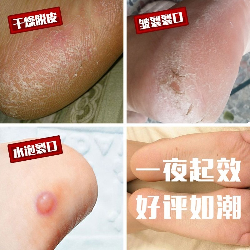 足跟防裂套護腳後跟保護套男士乾裂防皸裂腳裂的襪子護腳套女硅膠-細節圖3