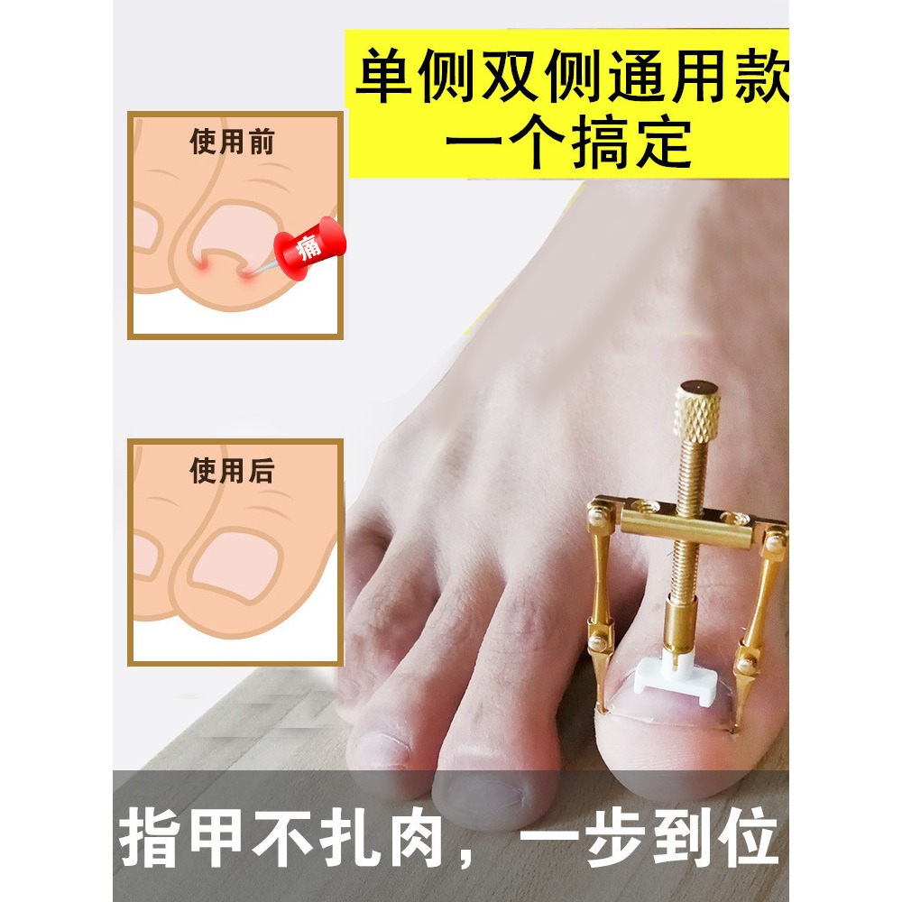 甲勾炎矯正器正甲貼甲溝嵌甲溝腳趾甲指甲長肉裏德國修正拉拉糾正-細節圖2