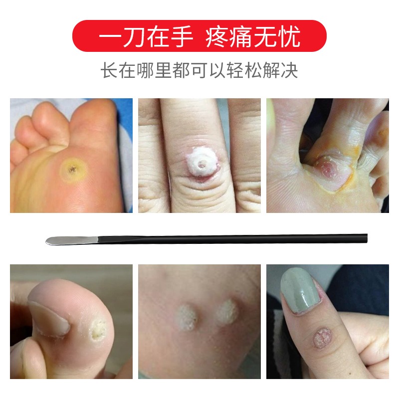 專業修腳刀修雞眼刀挖肉刺猴瘊去手足部腳底子老繭治蹠疣專用單件-細節圖2