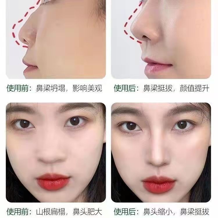 新款美鼻按摩器鼻樑縮鼻翼瘦鼻子挺鼻神器二角蝸牛刮痧鼻刮器-細節圖4