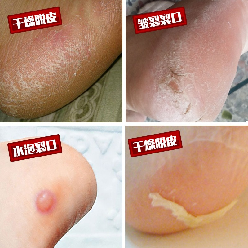 後跟貼硅膠腳後跟防乾裂保護套足跟防裂襪套子保濕防美腳磨皮-細節圖2