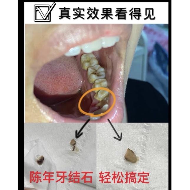 [BJ商城］台灣現貨 🇹🇼 電動牙刷情侶防水超聲波震動牙縫殘渣男女家用清潔去除牙結石神器-細節圖5