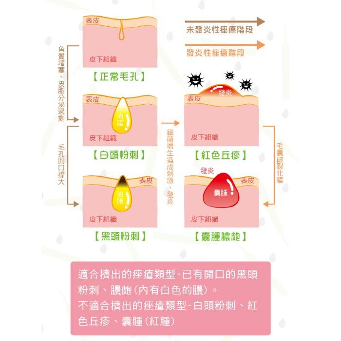 【貝麗瑪丹】再見奇異果粉刺夾 直型 尖型專業粉刺夾 1入-細節圖6