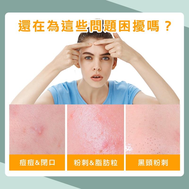 【台灣現貨 免運費！贈收納盒】不鏽鋼粉刺夾 挑痘針 黑頭粉刺 清粉刺 痘痘棒 去粉刺 粉刺棒 美容針 粉刺針 拔粉刺-細節圖2