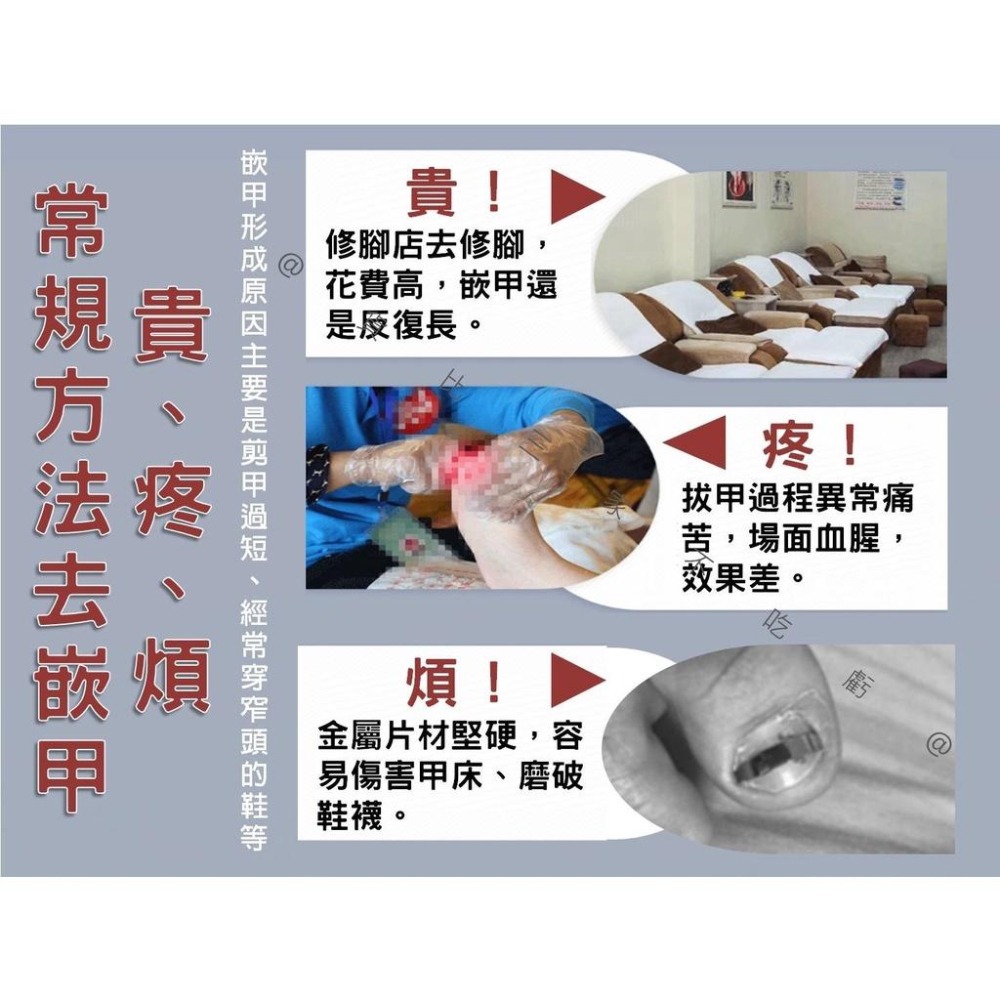 @貨比三家不吃虧@嵌甲矯正貼片 甲溝炎神器 嵌甲矯正器 凍甲貼片 指甲修護貼片 糾正指甲卷 無痕貼 正甲扣片 糾正肉包甲-細節圖2
