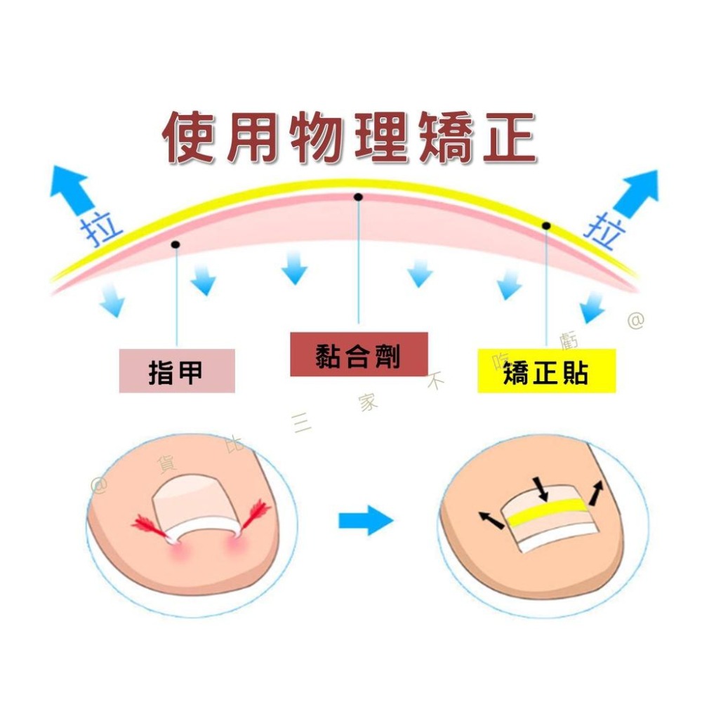 @貨比三家不吃虧@嵌甲矯正貼片 甲溝炎神器 嵌甲矯正器 凍甲貼片 指甲修護貼片 糾正指甲卷 無痕貼 正甲扣片 糾正肉包甲-細節圖3