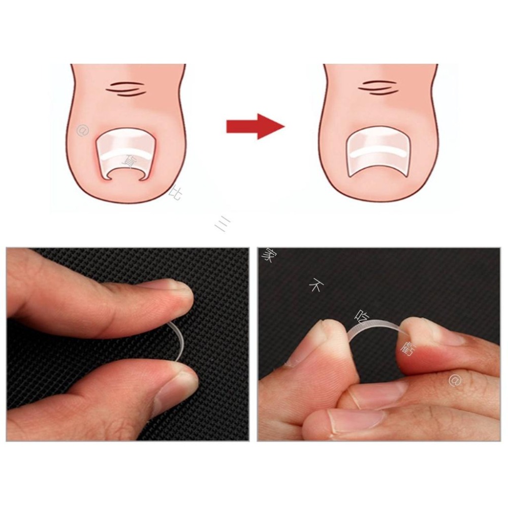 @貨比三家不吃虧@嵌甲矯正貼片 甲溝炎神器 嵌甲矯正器 凍甲貼片 指甲修護貼片 糾正指甲卷 無痕貼 正甲扣片 糾正肉包甲-細節圖4