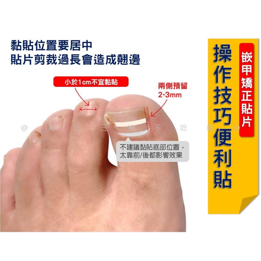 @貨比三家不吃虧@嵌甲矯正貼片 甲溝炎神器 嵌甲矯正器 凍甲貼片 指甲修護貼片 糾正指甲卷 無痕貼 正甲扣片 糾正肉包甲-細節圖5