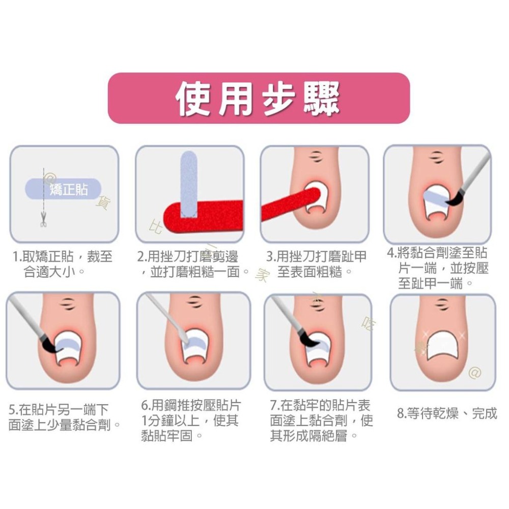 @貨比三家不吃虧@嵌甲矯正貼片 甲溝炎神器 嵌甲矯正器 凍甲貼片 指甲修護貼片 糾正指甲卷 無痕貼 正甲扣片 糾正肉包甲-細節圖6