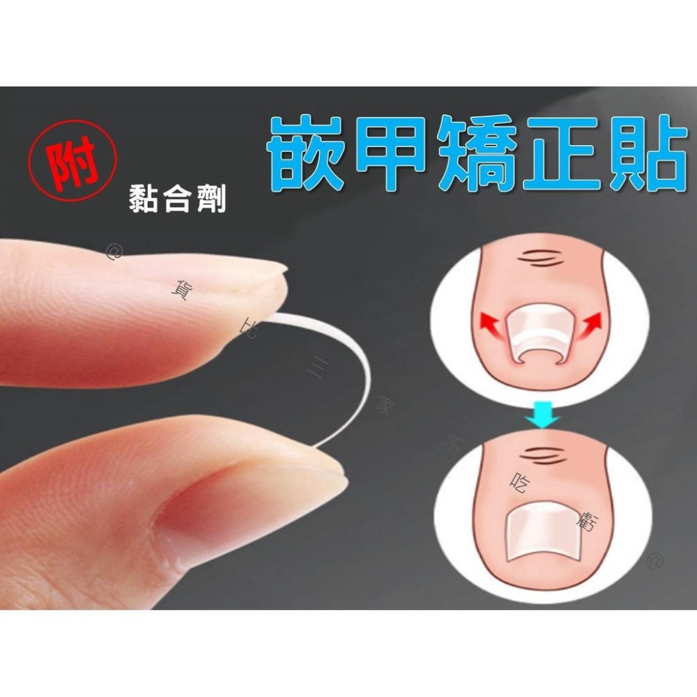 @貨比三家不吃虧@嵌甲矯正貼片 甲溝炎神器 嵌甲矯正器 凍甲貼片 指甲修護貼片 糾正指甲卷 無痕貼 正甲扣片 糾正肉包甲-細節圖8