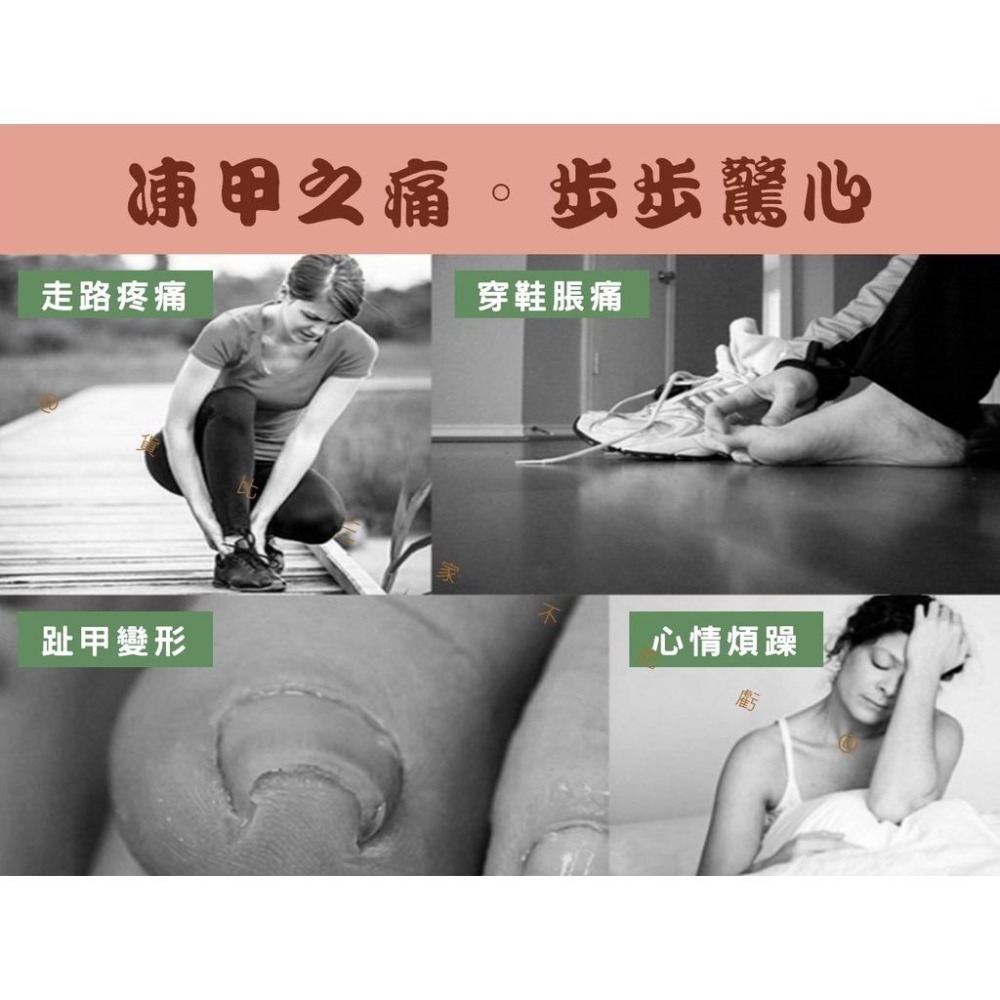 @貨比三家不吃虧@凍甲矯正器 糾正指甲 嵌甲 嵌甲矯正器 腳趾甲矯正器 足部保養 鷹嘴鉗 指甲剪工具 凍甲嵌甲矯正 腳趾-細節圖2