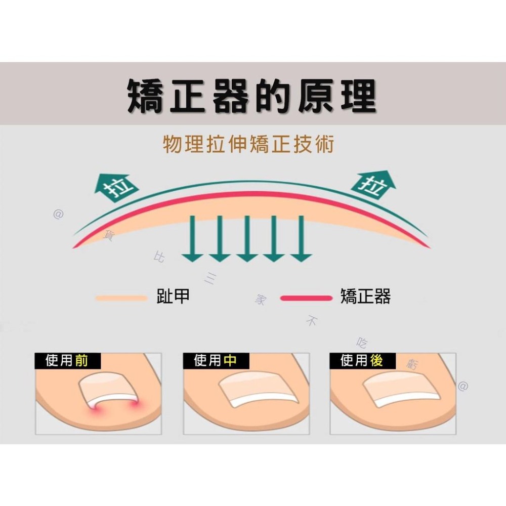 @貨比三家不吃虧@凍甲矯正器 糾正指甲 嵌甲 嵌甲矯正器 腳趾甲矯正器 足部保養 鷹嘴鉗 指甲剪工具 凍甲嵌甲矯正 腳趾-細節圖3