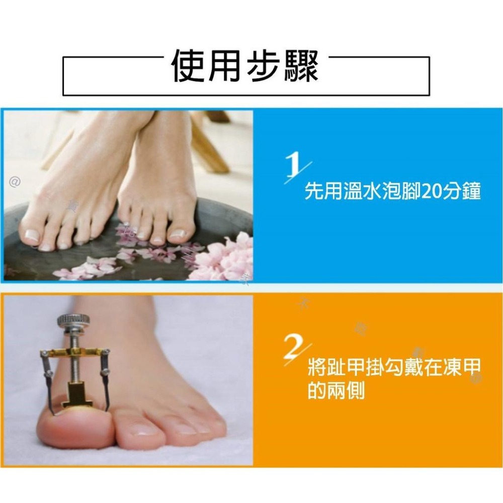 @貨比三家不吃虧@凍甲矯正器 糾正指甲 嵌甲 嵌甲矯正器 腳趾甲矯正器 足部保養 鷹嘴鉗 指甲剪工具 凍甲嵌甲矯正 腳趾-細節圖4
