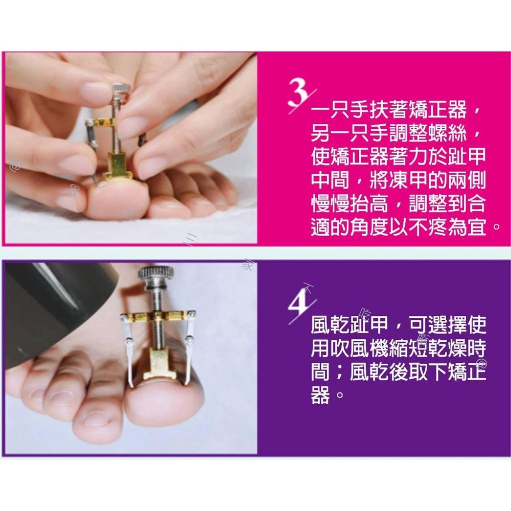 @貨比三家不吃虧@凍甲矯正器 糾正指甲 嵌甲 嵌甲矯正器 腳趾甲矯正器 足部保養 鷹嘴鉗 指甲剪工具 凍甲嵌甲矯正 腳趾-細節圖5