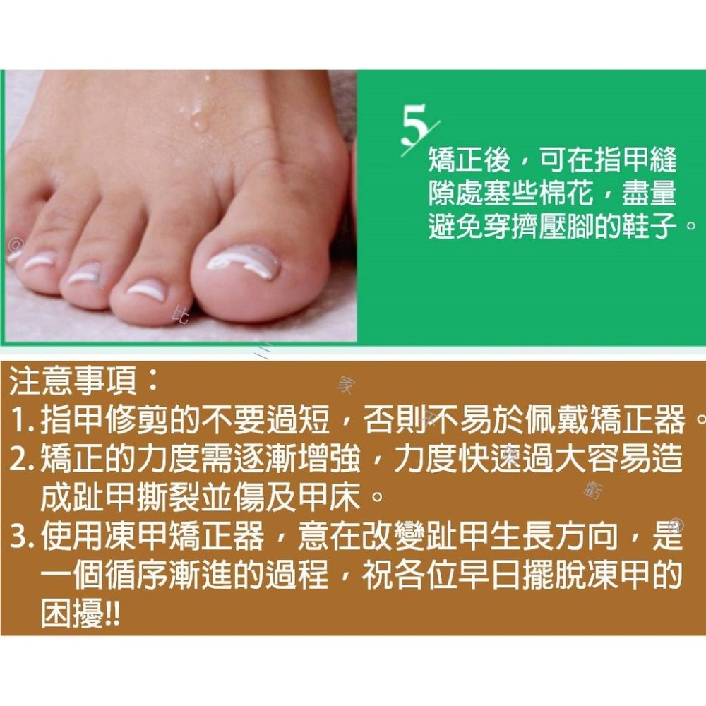 @貨比三家不吃虧@凍甲矯正器 糾正指甲 嵌甲 嵌甲矯正器 腳趾甲矯正器 足部保養 鷹嘴鉗 指甲剪工具 凍甲嵌甲矯正 腳趾-細節圖6