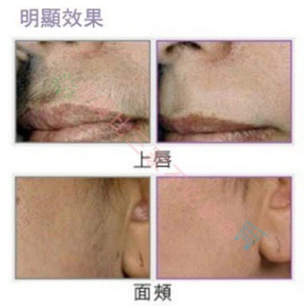 @貨比三家不吃虧@ Slique 臉部除毛器 棉線 拔毛器 脫毛夾 手動 拔毛 女人我最大 除汗毛 挽臉棒 去毛器 唇毛-細節圖5