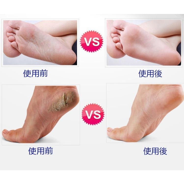 🎉專注3C🎉 德國磨腳神器👠搓腳板 搓腳棒 輕鬆省力 腳皮刀 去老繭 修皮剉 腳皮挫 磨腳器 磨腳刀👠-細節圖6