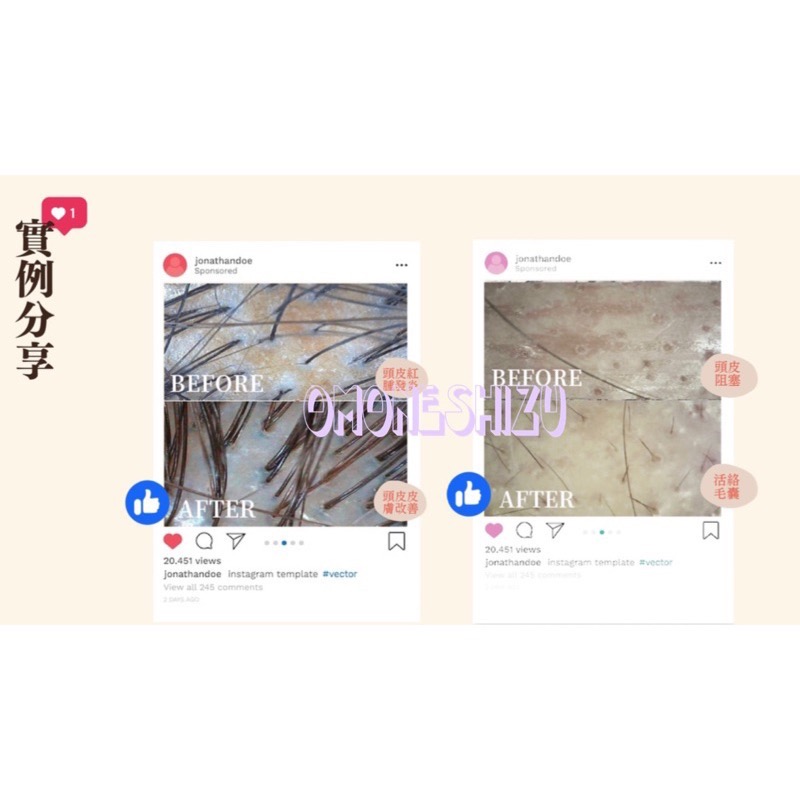 植森生技 深層 全方位 無矽 無藥 雄性禿毛囊 頭皮屑 落髮修護 髮質 精油 蓬鬆 產後 生髮 養髮 禿頭-細節圖4