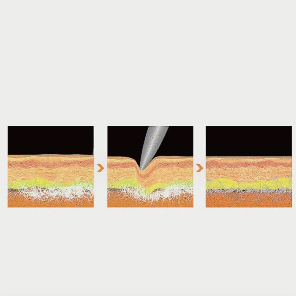 【健人體育🔥現貨】316不鏽鋼筋膜刀組 筋膜刀 按摩刀 筋膜刀 理療 刮痧 刮痧按摩 刮痧器 大M刀 探掃刀 蝙蝠刀-細節圖9