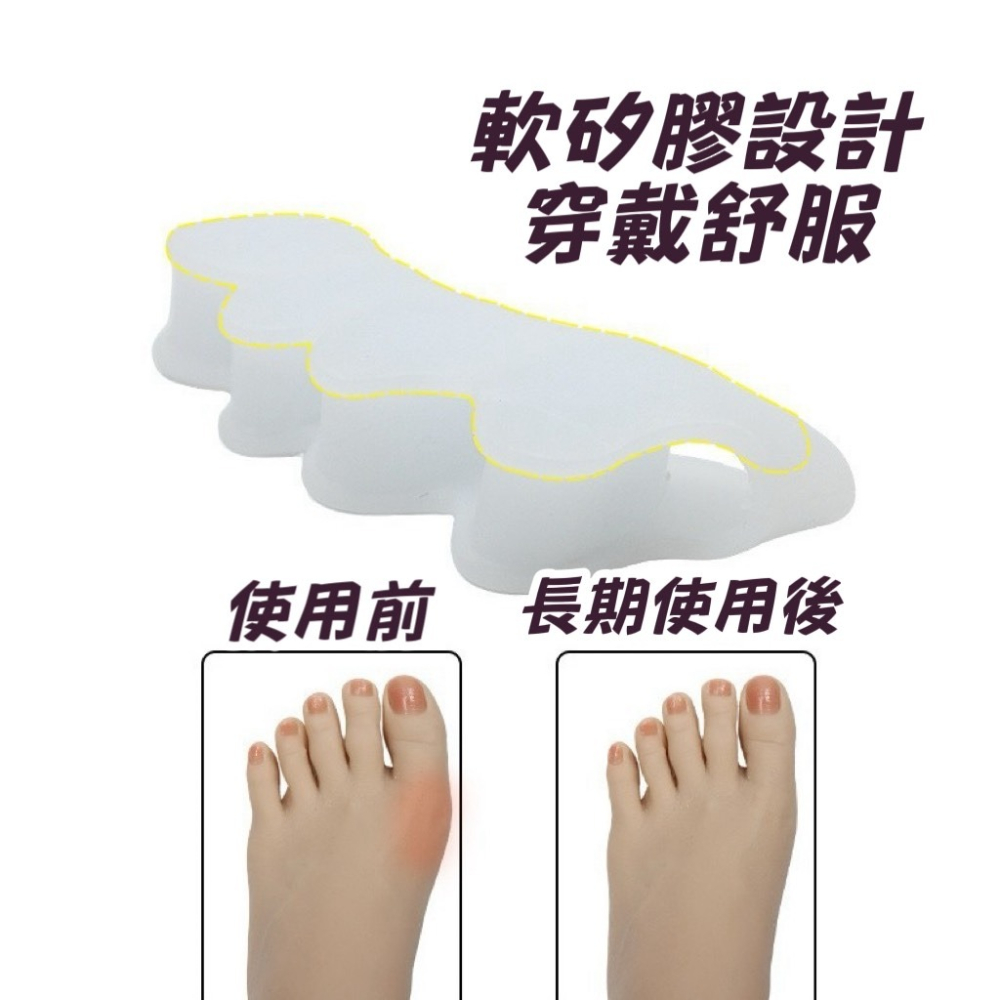 鳥我一下好嗎🍀矽膠分趾器 拇指外翻用 日夜用 腳趾重疊擠壓分離器 腳趾固定器 保護腳趾 防痛 腳指頭分離 腳趾 指頭套-細節圖6