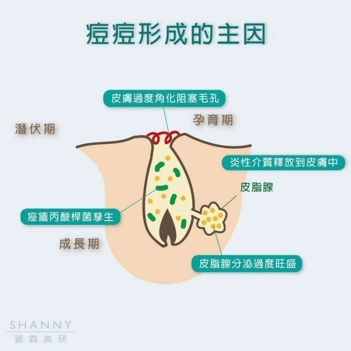 【Shanny萱霓美研】茶樹調理痘痘凝霜 | 痘痘  怯痘膏 怯印霜 怯痘印 怯印  怯痘痘 青春痘 怯痘-細節圖5