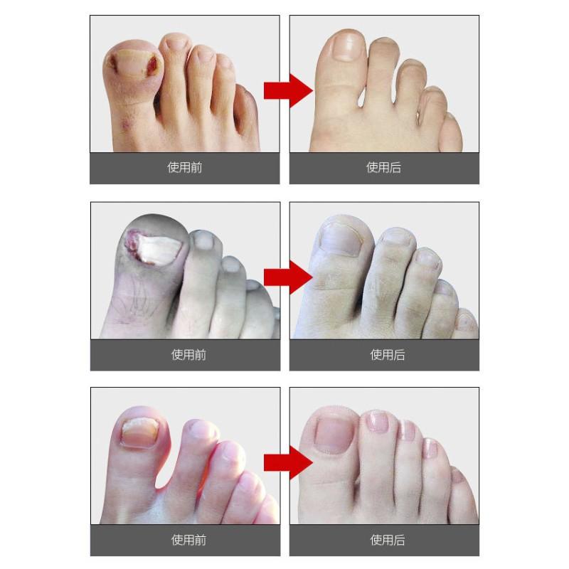 [現貨秒發!] 不鏽鋼剔甲組 鷹嘴鉗 【壹零二二】三合一折疊鷹嘴鉗 去死皮尖嘴鉗 剪腳趾甲修腳剪嵌甲【E0220176】-細節圖8