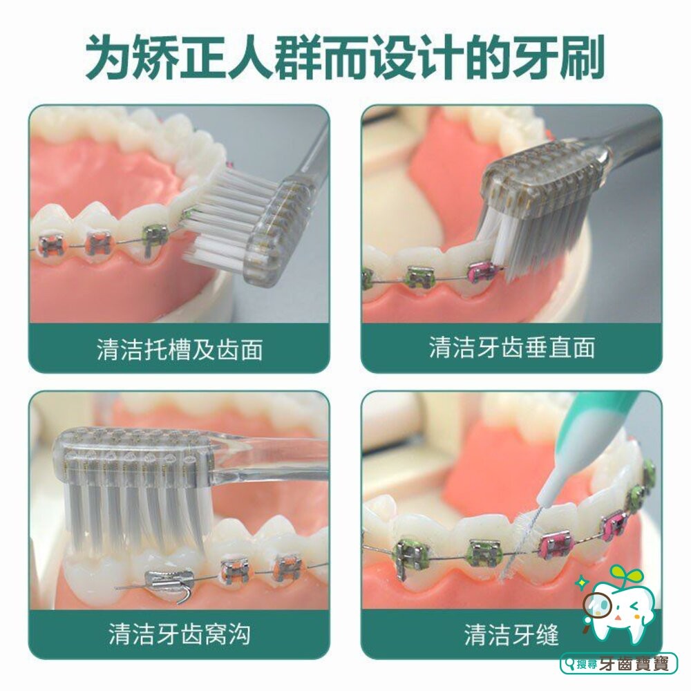 SILVER 矯正專用 凹型軟毛抗菌Ag+銀離子矯正牙刷一支-細節圖3