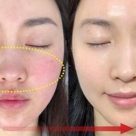 韓國MEDI-PEEL ☘️ 積雪草 安瓶精華面膜 #改善泛紅 #粉刺 #去痘-細節圖3