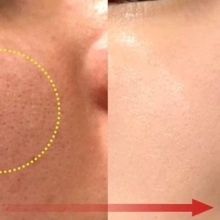 韓國MEDI-PEEL ☘️ 積雪草 安瓶精華面膜 #改善泛紅 #粉刺 #去痘-細節圖4