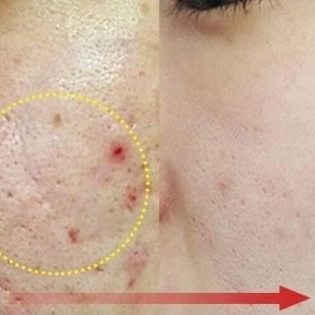 韓國MEDI-PEEL ☘️ 積雪草 安瓶精華面膜 #改善泛紅 #粉刺 #去痘-細節圖5