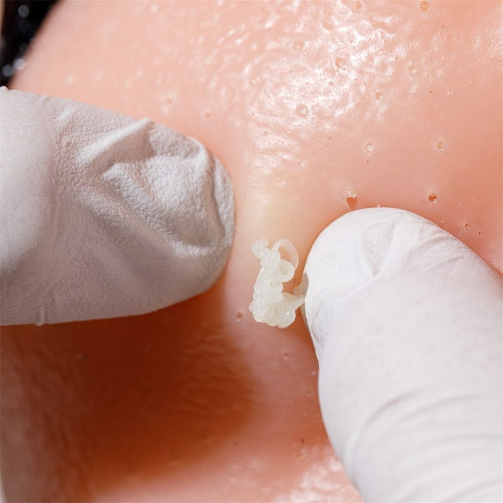 超紓壓擠痘痘玩具 擠黑頭粉刺 爆漿痘 可更換粉刺 草莓鼻 黑頭粉刺-細節圖2