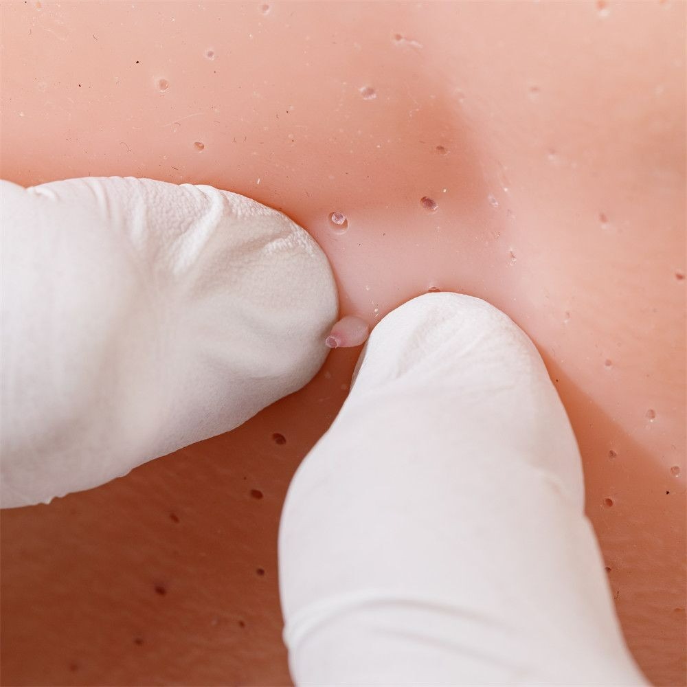 超紓壓擠痘痘玩具 擠黑頭粉刺 爆漿痘 可更換粉刺 草莓鼻 黑頭粉刺-細節圖4