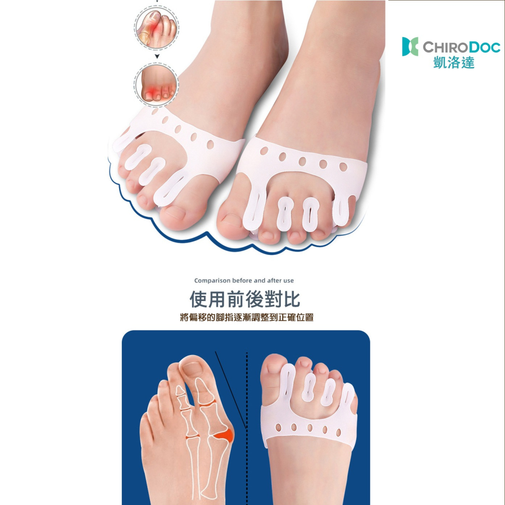 【原廠正品】ChiroDoc五指美腿分趾套（一雙） -美腿分趾器 腳趾 五指 拇指外翻 矽膠指環 腳趾紓壓 O型腿矯正器-細節圖7