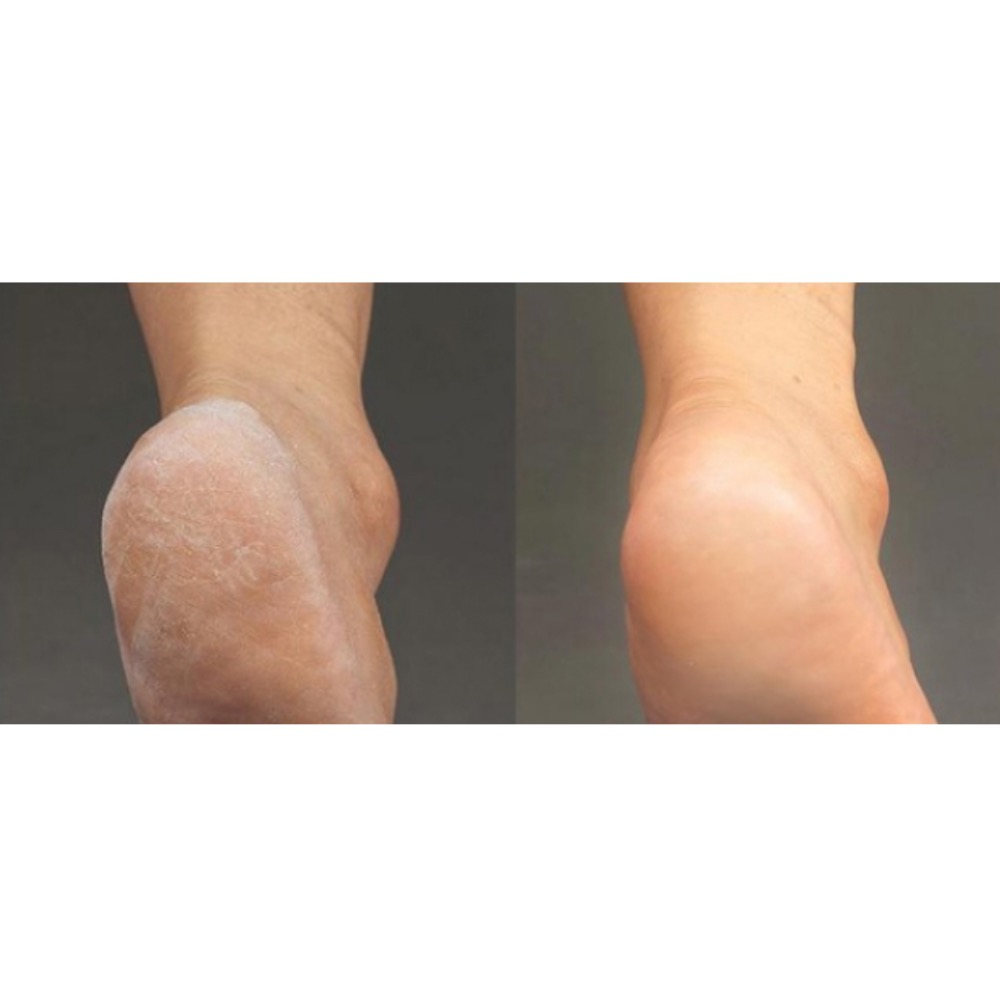 現貨 韓國代購 baren 腳後跟修護組 Set, 足部軟化劑 100毫升 1入 + 腳銼 1入, 100ml, 1組-細節圖6