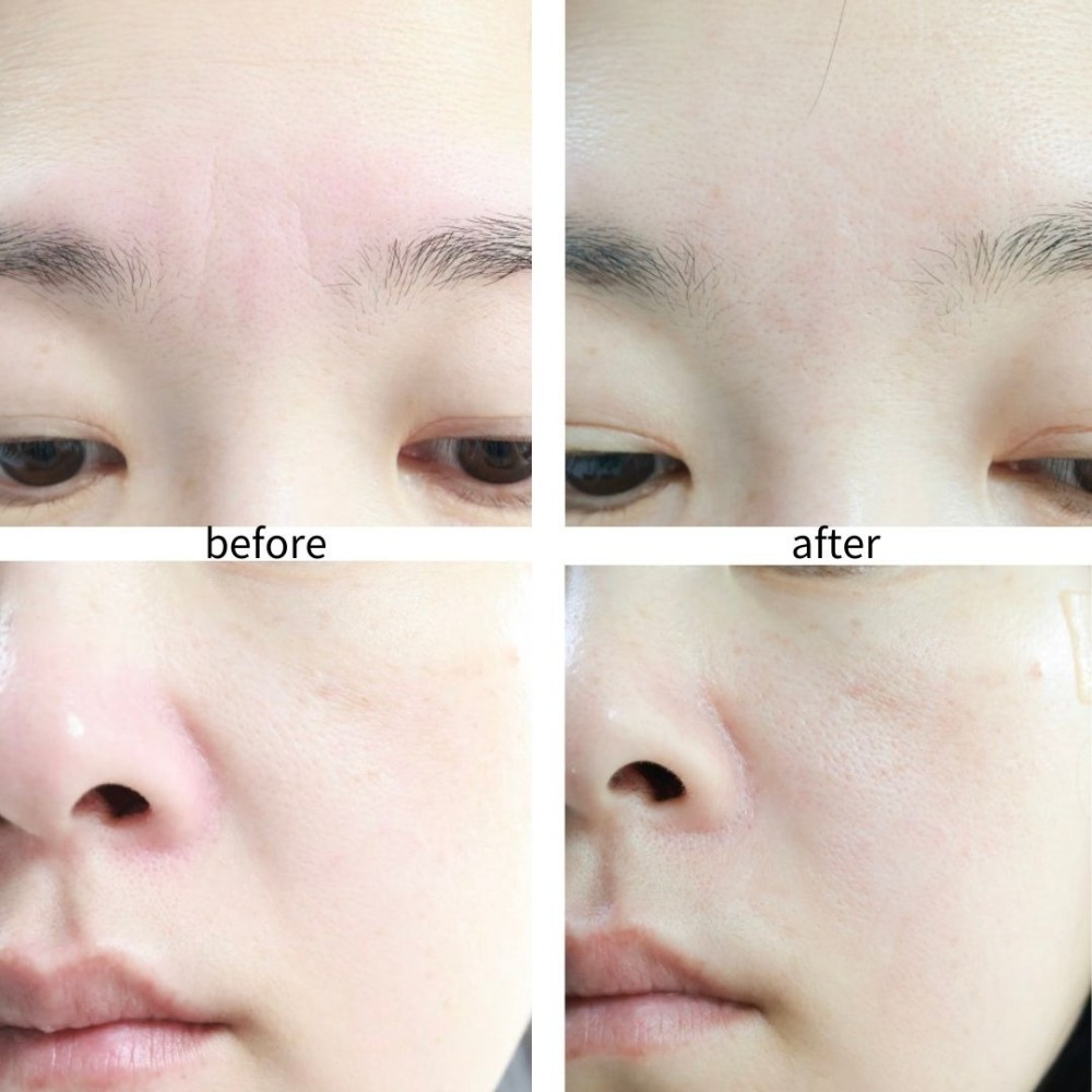 MEDITHERAPY｜微針貼片 微笑紋 維他命 亮白貼 綠淨光 毛孔 深層 去紋貼  微針 眉紋貼｜DBK生活美學｜-細節圖7