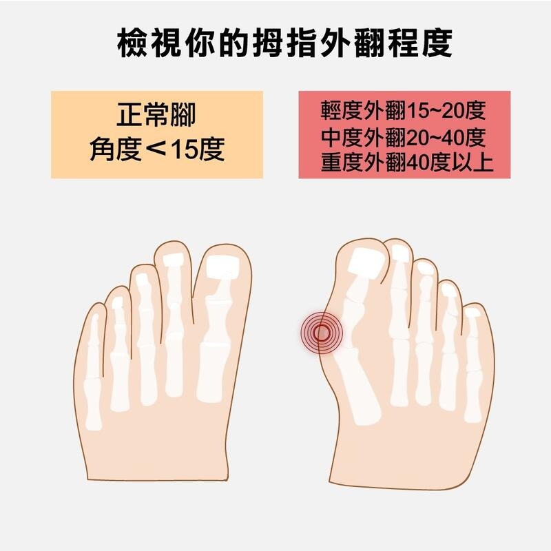 ＂爾東體育＂ new buffalo 牛頭牌 拇指外翻專用鞋 土豆外出鞋 土豆星球鞋 高彈力 休閒鞋 拇指外翻鞋 減壓鞋-細節圖3