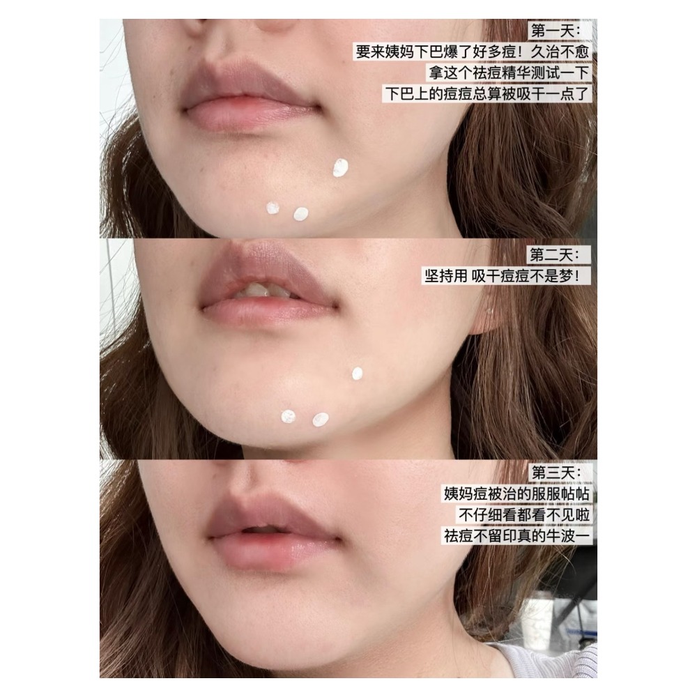 戴栗ლ大水滴 ʙɪɢ ᴅʀᴏᴘ去痘精華 1.0/2.0🩵-細節圖9