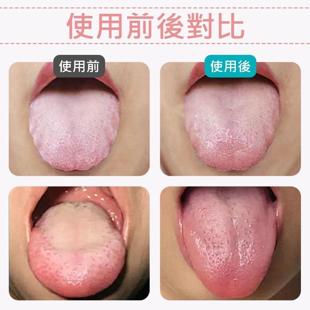 【刮+刷二合一舌苔刷  刮舌棒】 舌苔清潔器 舌苔刷 刮舌器 刮舌苔器  舌苔清潔 牙刷-細節圖4