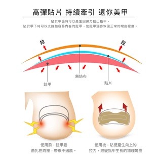免膠 甲溝嵌甲正甲貼 正甲貼 甲溝嵌 甲矯正器 腳趾甲貼 美甲貼 歐文購物-細節圖4