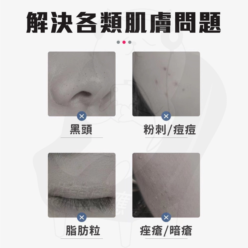 《升級款》超尖頭粉刺夾 [24h發貨][開發票] 加硬粉刺夾 粉刺針 粉刺鉤 粉刺圈 斜頭夾 美容工具 美妝保養-細節圖2