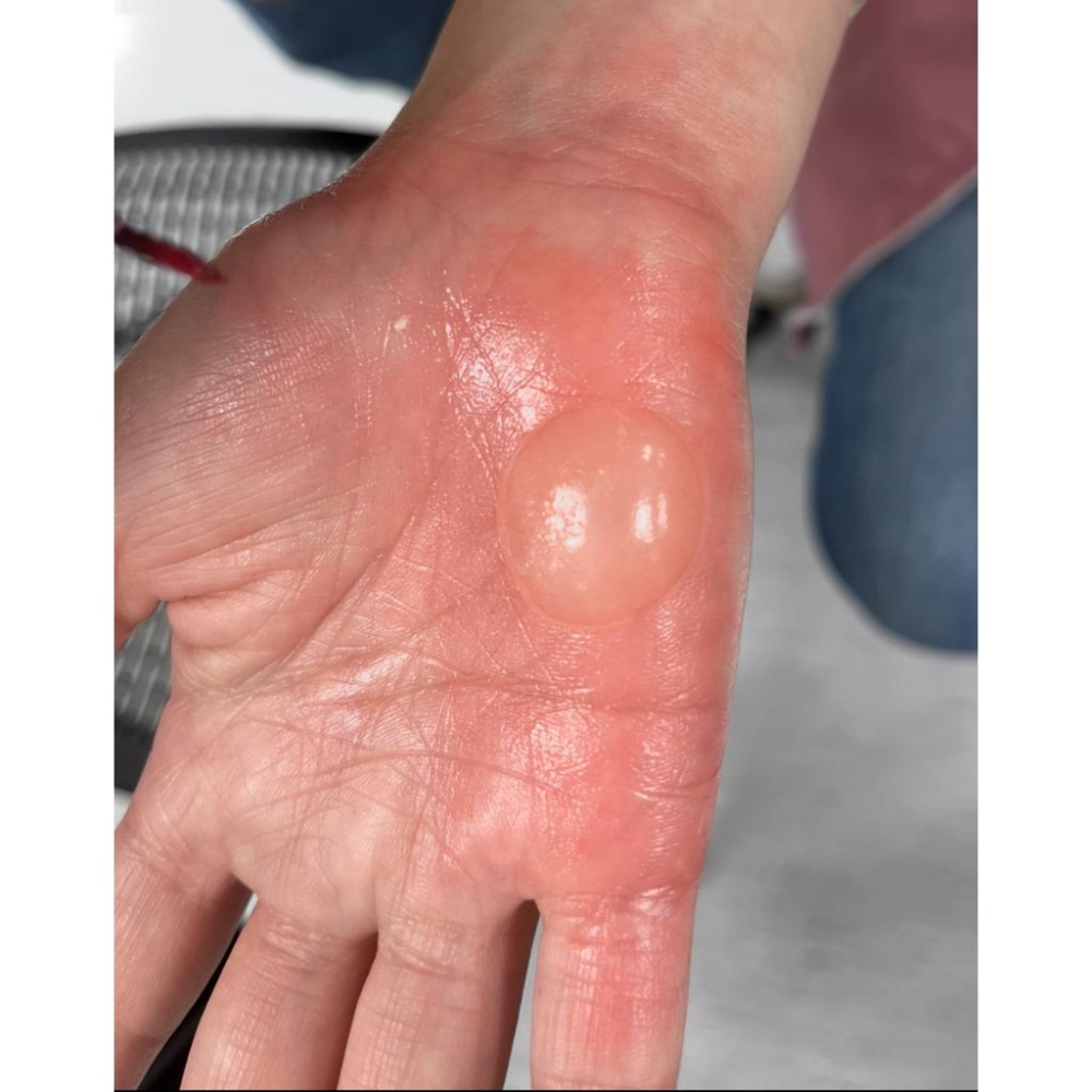 燒燙傷凝膠 明膠 Effects Gel 美國原裝BenNye 透明水泡 血塊 腫脹 疤痕 血跡 割傷 撕裂傷-細節圖2