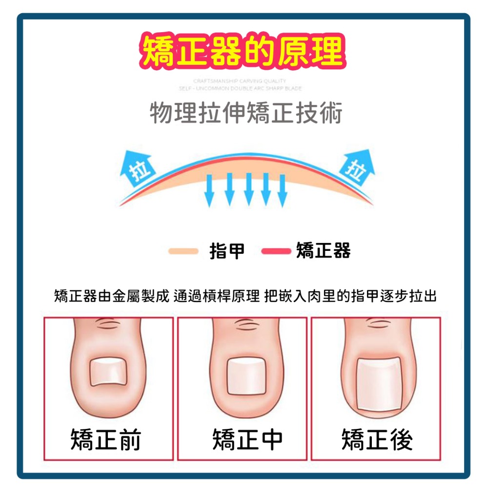 指甲矯正器【178小舖】七件組 嵌甲 凍甲 卷甲 矯正器 甲溝炎 指甲內陷 指甲內陷矯正 指甲蜷曲 嵌甲矯正器 指甲矯正-細節圖6