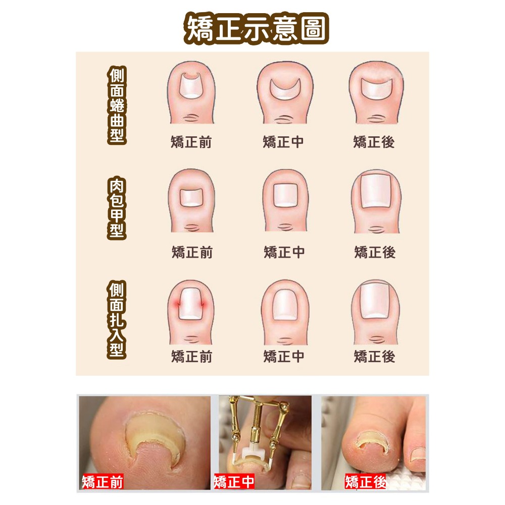 指甲矯正器【178小舖】七件組 嵌甲 凍甲 卷甲 矯正器 甲溝炎 指甲內陷 指甲內陷矯正 指甲蜷曲 嵌甲矯正器 指甲矯正-細節圖8